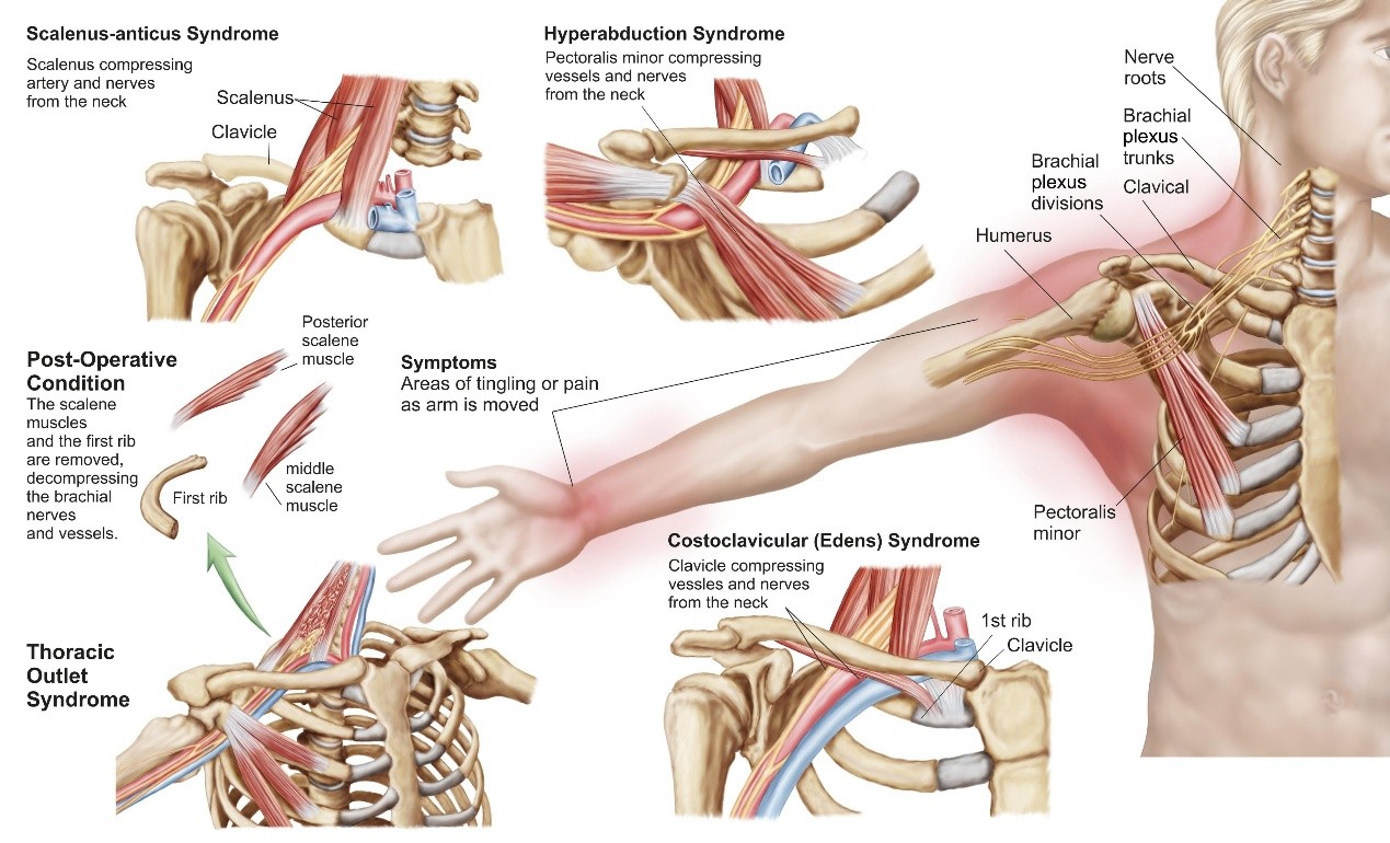 Elevated First Rib