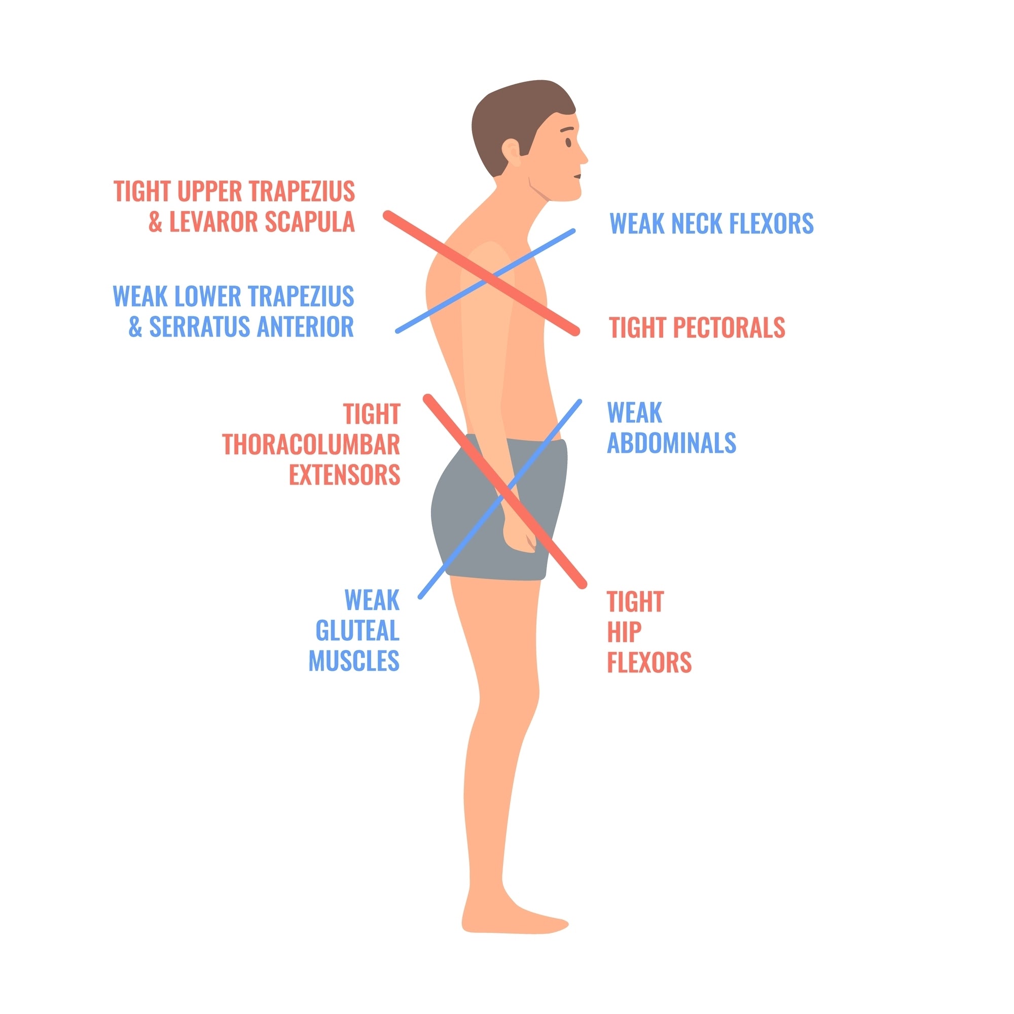 Postural kyphosis 2